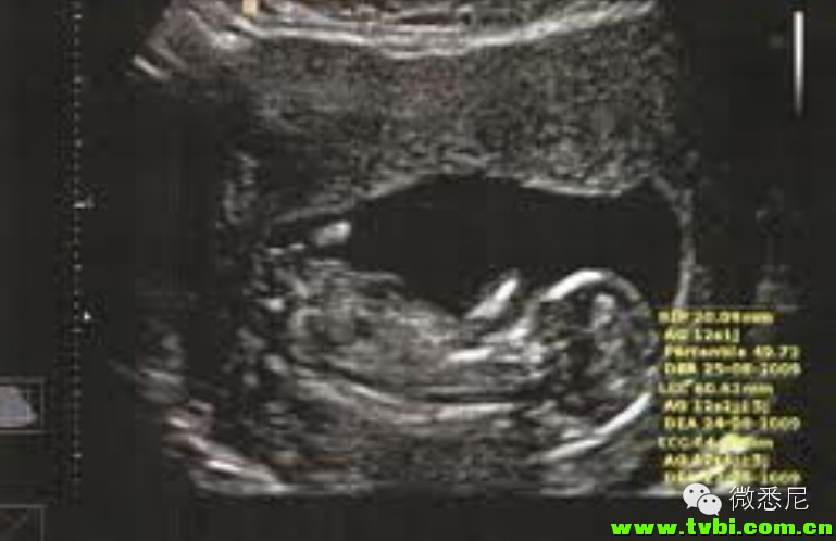 剖腹产全程拍摄，看完后震惊了！附澳洲生产经验(请转给需要的人) ...