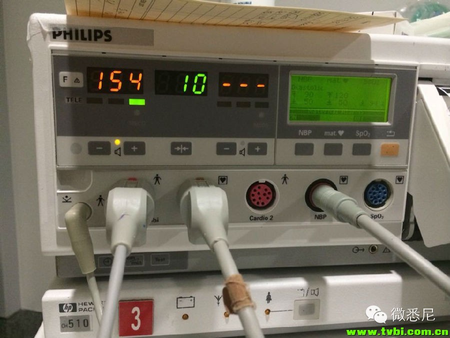 剖腹产全程拍摄，看完后震惊了！附澳洲生产经验(请转给需要的人) ...