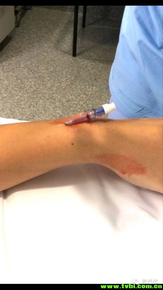 剖腹产全程拍摄，看完后震惊了！附澳洲生产经验(请转给需要的人) ...